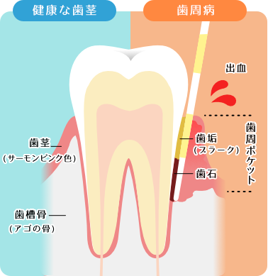 歯周ポケット検査イメージ